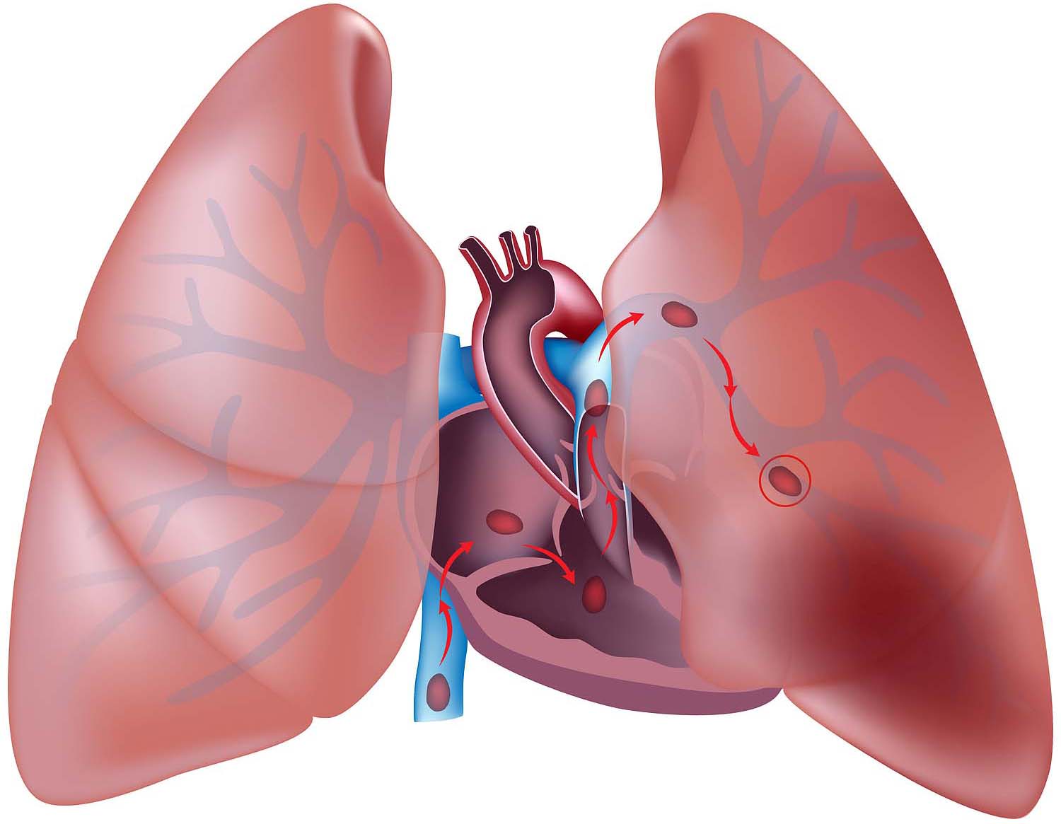 NuvaRing Pulmonary Embolism Increased Risks, Causes & Symptoms
